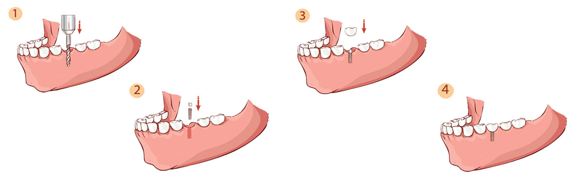 Camdenton The Dental Implant Procedure